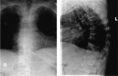 تصویر 2. رادیوگرافی مهره، قدامی- خلفی (A) و جانبی (B) بیمار مبتلا به سرطان‌ پروستات متاستاتیک. ضایعات استئوبلاستیک در مهره‌های T12 و L1 مشاهده می‌شود.