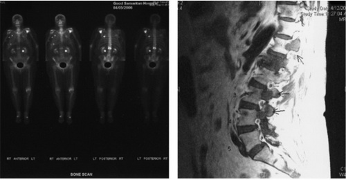 تصویر 3. اسکن استخوان (A) و MRI اسکن (B) یک خانم مبتلا به سرطان ‌پستان متاستاتیک. اسکن استخوان تنها ضایعه‌ای غیرطبیعی را در مهره‌ی L1 نشان می‌دهد، در حالی که در MRI، ضایعات متعددی در پدیکول‌های مهره‌های T12، L3 و L4 نیز دیده می‌شوند.