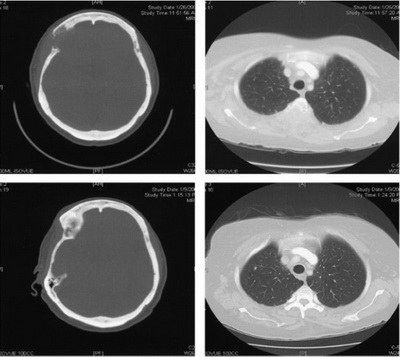 تصویر 4. CT اسکن بیمار مبتلا به سرطان‌ پستان متاستاتیک. تصاویر فرونتال جمجمه (A) و مهره‌ی توراسیک (B) نشانگر ضایعات استخوانی تخریبی وسیع هستند. تصاویر یک سال بعد (C و D) پس از اجرای رادیوتراپی، نشانگر ترمیم ضایعات مذکورند.