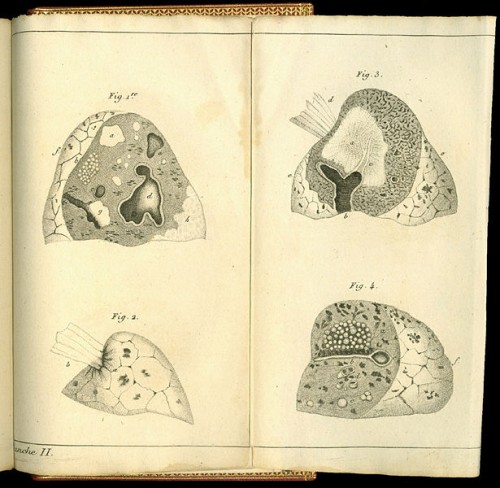 615px-Rene-Theophile-Hyacinthe_Laennec_(1781-1826)_Drawings_diseased_lungs