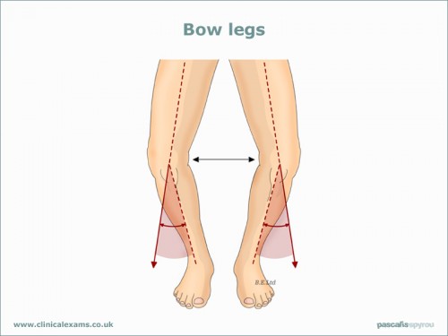 Bow-legs-web-large(800x600)