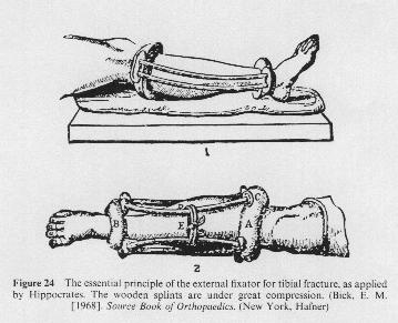 فیکس کردن استخوان تیبیا در عصر بقراط و دیوکلس